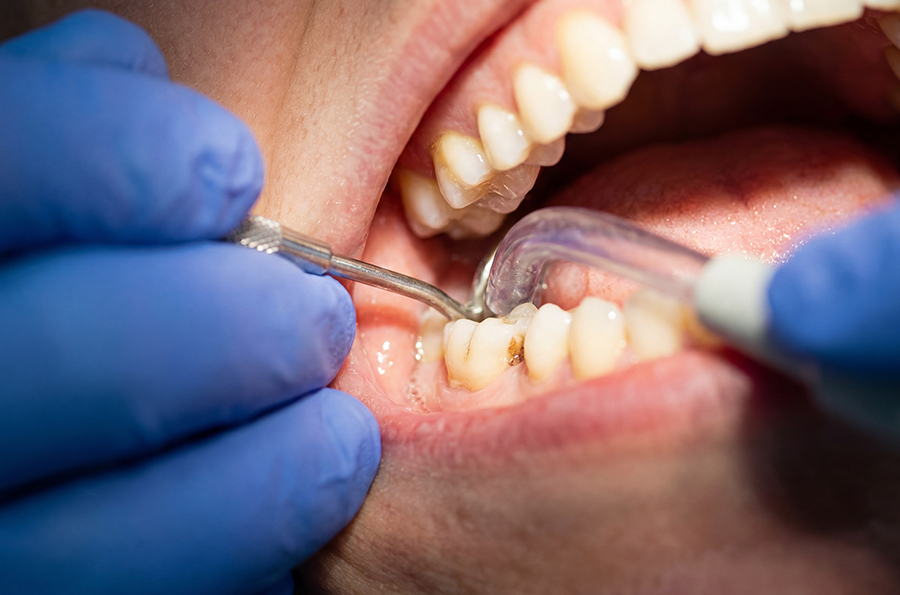 Professional teeth cleaning at Precision Medical Center
