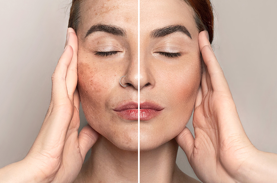 Pigmentation and dark spot correction at Precision Medical Center